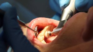 Полировка зубов щеточкой, как один из этапов профессиональной чистки