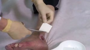 Хитопран - биополимерная повязка с хитозаном