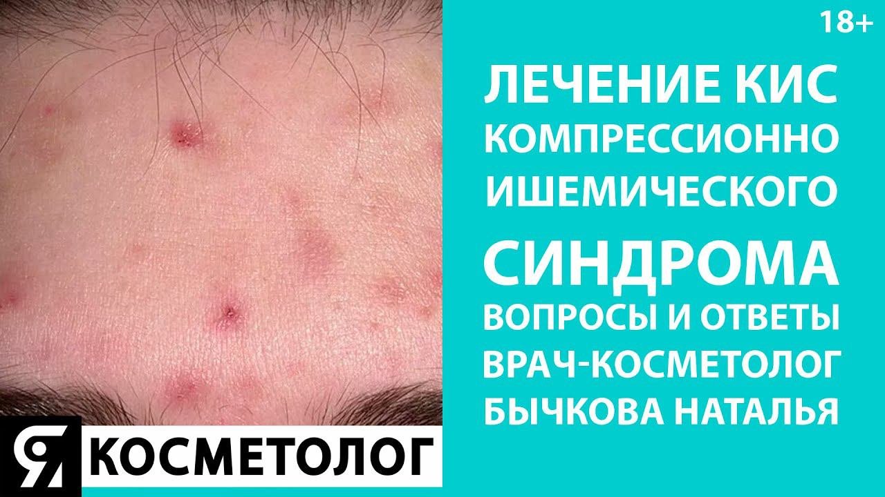 Лечение компрессионно-ишемического синдрома: вопросы и ответы. Врач-косметолог Бычкова Наталья.