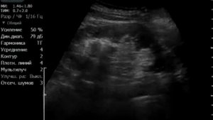 пункция кисты почки