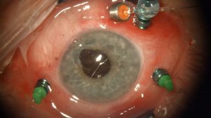 IOL in the vitreous cavity + Safety-basket + Secondary IOL implantation + Iris suture correction