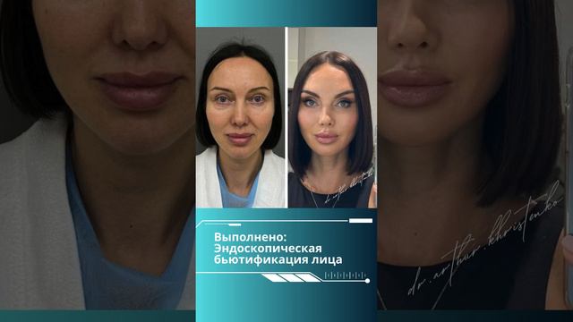 ✅Выполнено:Эндоскопическая бьютификация лица.