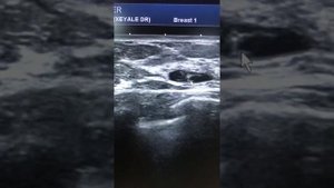 Süd vezinin axardaxili papilloması.  Интрадуктальная папиллома груди.