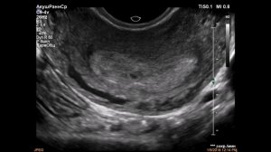 Маточная беременность раннего срока, плодное яйцо