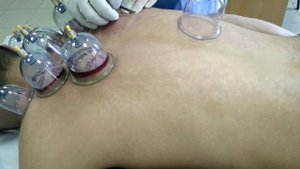 Как делать хиджаму? Видео вкратце. حجامة الظهر
