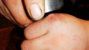 Достаём металлический осколок из под кожи при помощи поискового магнита.