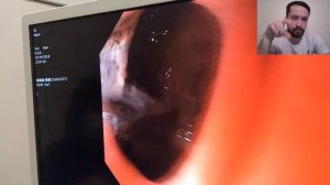 Эндоскопическое исследование. Кровотечение. FORREST?/ Endoscopy. Complication of peptic ulcer