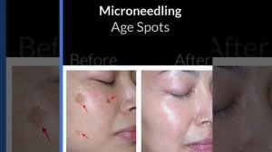 ? Microneedling - Collagen Induction Therapy -  Uses, Benefits, Before-After Photos (Acupuncture)