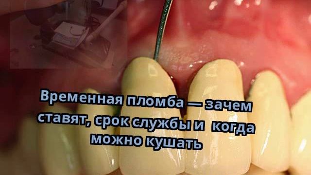 Временная пломба — зачем ставят, срок службы и  когда можно кушать