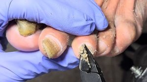 All the nails are infected by onychomycosis and are covered with black mud【Doctor Liu Pedicure】