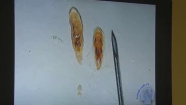 Про Описторх (двуустка кошачья) и Описторхоз смотреть онлайн