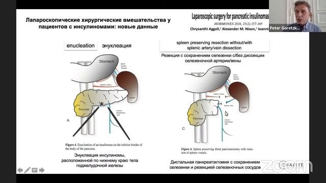 Современная диагностика и методы лечения пациентов с панкреатогенной гипогликемией