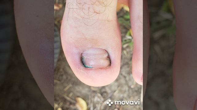 Удар ногтя, полугодовое восстановление. смотреть онлайн