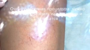 Как убрать венозную сетку