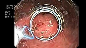 Лигирование Olympus ( Устройство для наложения лигатур на варикозно расширенные вены пищевода)