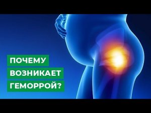 Почему возникает геморрой?