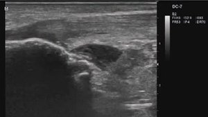 Анонс Лекция6 УЗД заболеваний и травм голеностопных суставов