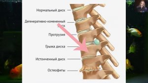 Остеохондроз. Продолжение. Урок 6. Остеофиты. Истонченный диск. Протрузия. Грыжа.