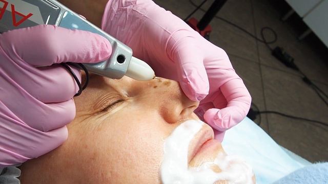 Процедура удаления возрастных пигментных пятен на носу методом холодной плазмы