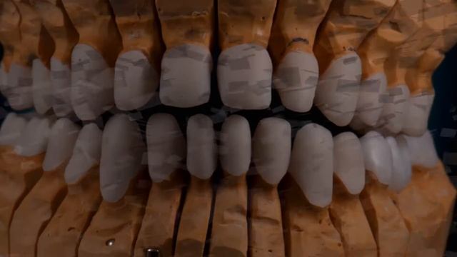 Восстановление зубов винирами IPS e.max Press смотреть онлайн