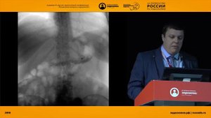 КОМПЛЕКСНОЕ ЛЕЧЕНИЕ ПАЦИЕНТКИ С ТЯЖЕЛЫМ СИНДРОМОМ МАЛЬАБСОРБЦИИ ПОСЛЕДИСТАЛЬНОГО ГАСТРОШУНТИРОВАНИЯ