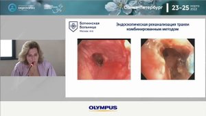 Современная бронхоскопия -  едина в трех лицах