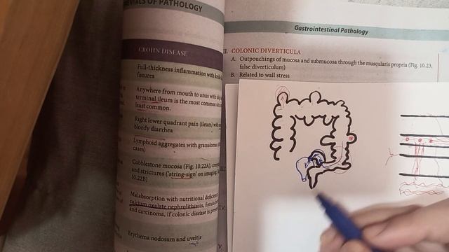 GIT pathology of large intestine part 2 смотреть онлайн