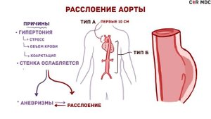 Расслоение аорты - причины, симптомы, диагностика, лечение - кратко