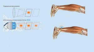 Ударно-волновая терапия. Опыт применения  аппарата ударно-волновой терапии Dornier Aries.