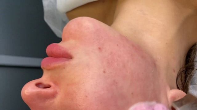 Ультразвуковая чистка, АППАРАТНАЯ ЧИСТКА ЛИЦА смотреть онлайн