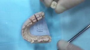 Видео о том, как правильно устанавливают коронки.