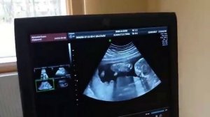 УЗИ плода на 17 неделе