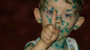 Чем Отличается ЙОД от ЗЕЛЕНКИ? Чем СОВРЕМЕННЫМ их заменить? В каких случаях