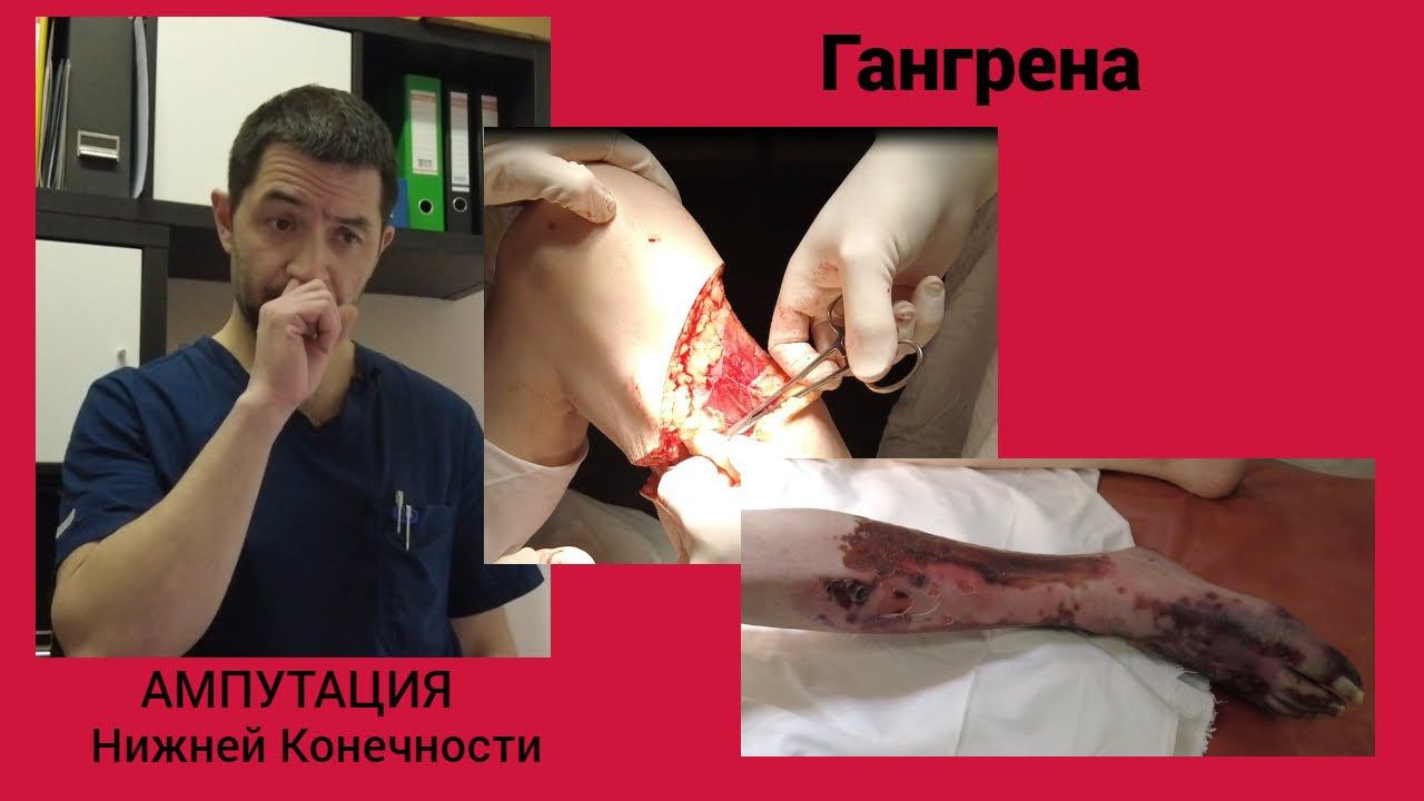 Гангрена. Ампутация нижней конечности.