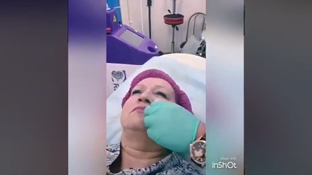 Коррекция носогубных складок.mp4