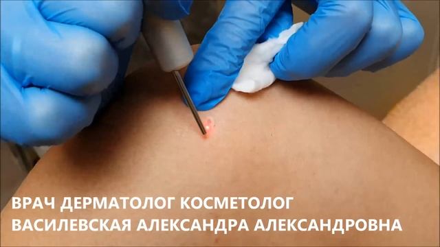 Удаление бородавки смотреть онлайн