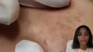 Blackheads Popping pimple Spa Relaxing beauty 2023 #2