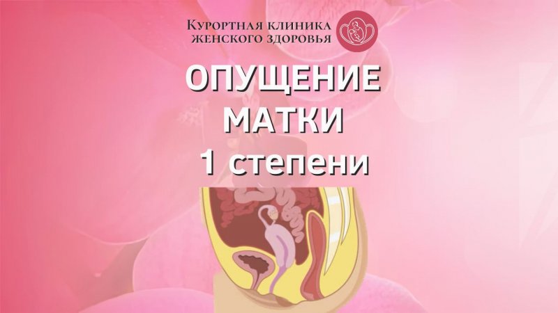 Опущение матки 1 степени