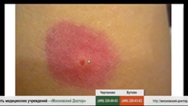 Укус блохи смотреть онлайн