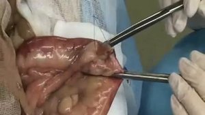 Мастер-класс резекция тонкого кишечника с выполнением кишечного анастомоза конец в конец.