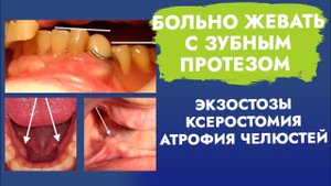 Больно жевать с зубным протезом. Экзостозы. Ксеростомия. Атрофия челюстей.