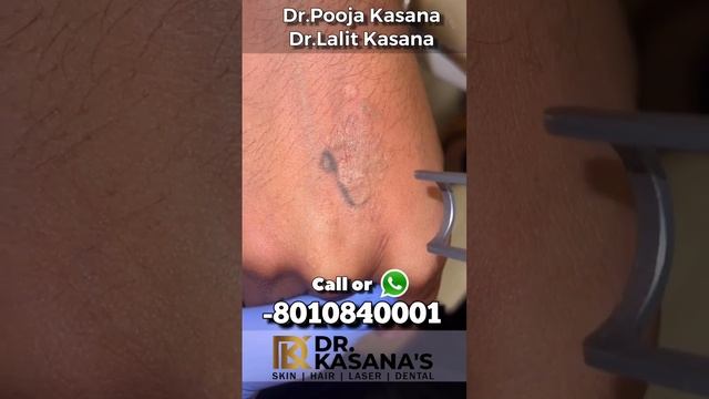 World’s best laser for Tattoo Removal Treatment at Dr  Kasana’s Clinic