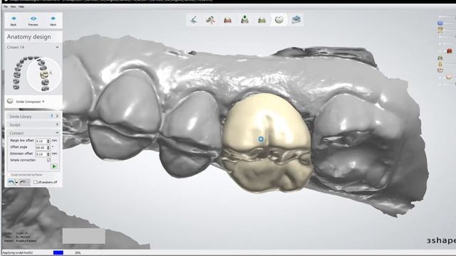 3 Shape Crown design & Virtual articulator