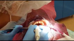 детская ультразвуковая чистка зубов (гигиена полости рта)