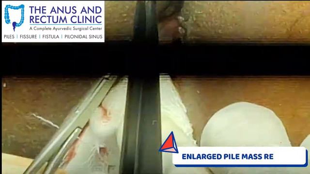 THROMBOSED PILES / THROMBOSED HAEMORRHOIDS SURGERY смотреть онлайн