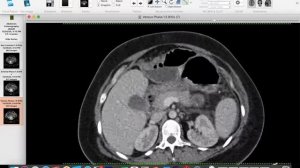 | GIT | Emergency | Post CS Acute perforated appendicitis and paralytic ilius.