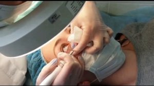 Папиллома на веке