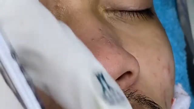 Relaxing Acne Treatment Acnes Treatment 128 смотреть онлайн