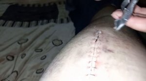 снятие скоб со шва без антистеплера