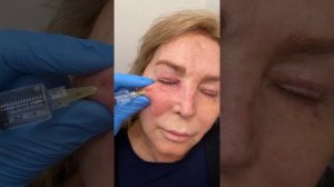 Dissolving Juvederm Filler | Live with Dr. Nadir Qazi